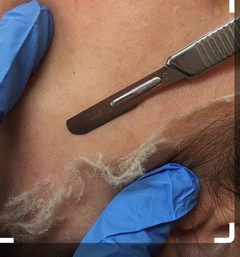Dermaplaning